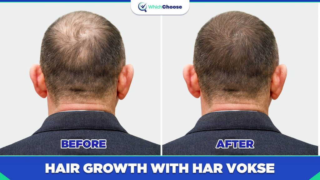 Har Vokse Before And After