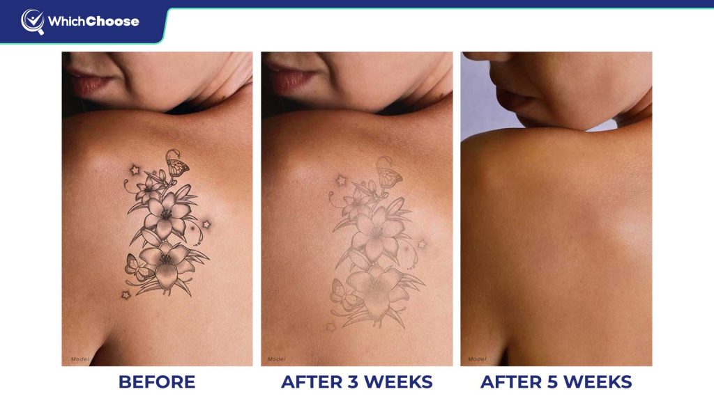 How Does The Laserless Tattoo Removal Guide Work?